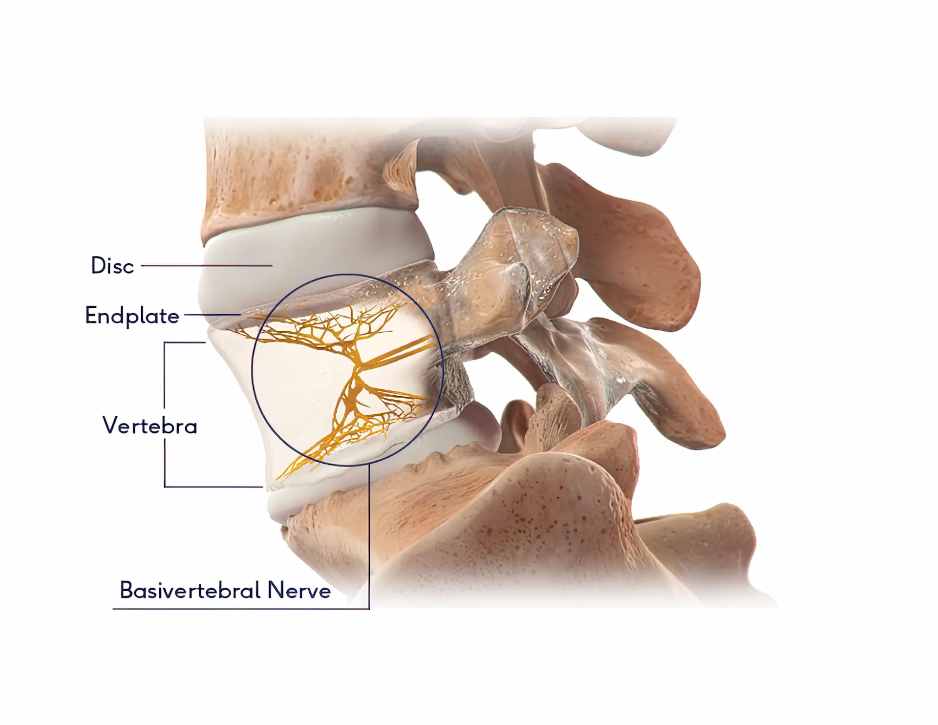 The Intracept Procedure