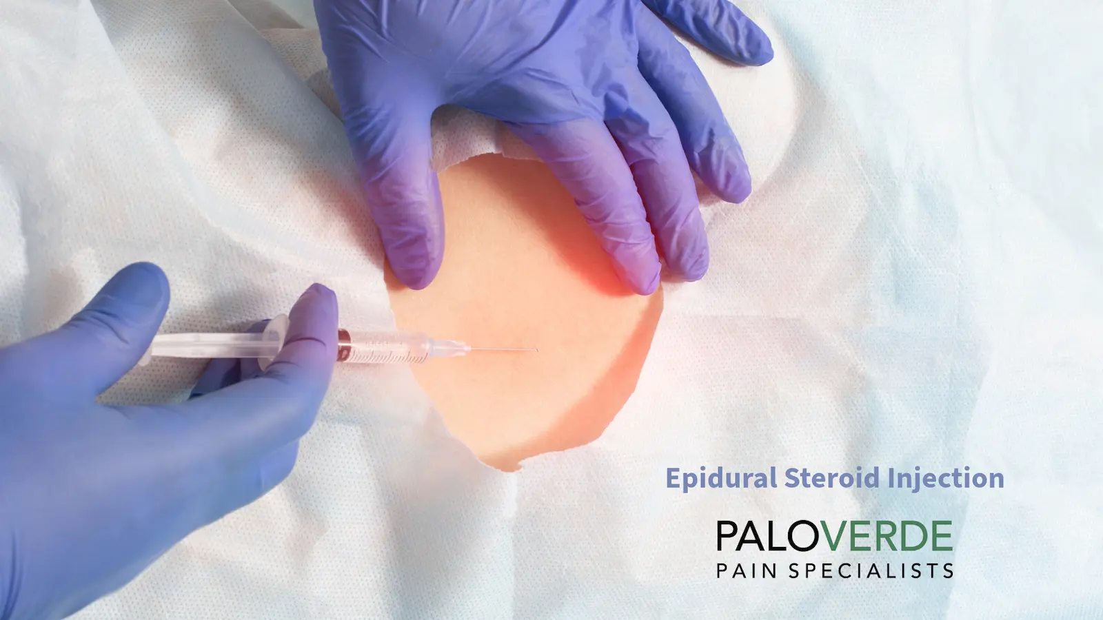 Epidural Steroid Injection